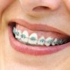 歯列矯正の早送りGIF画像 歯が矯正されていく様子がヤバいｗｗｗｗｗ