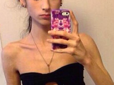 拒食症の骨皮ｶﾞﾘｶﾞﾘ女性 ボディビルに目覚め生まれ変わった結果 → 画像