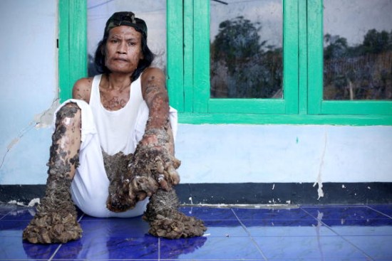 Indonesian "Tree Man" Continues Treatment For Human Papilloma Virus