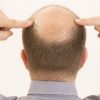 【ハゲ活】薄毛男性に対する『女性の本音』408人に聞いてみた結果……